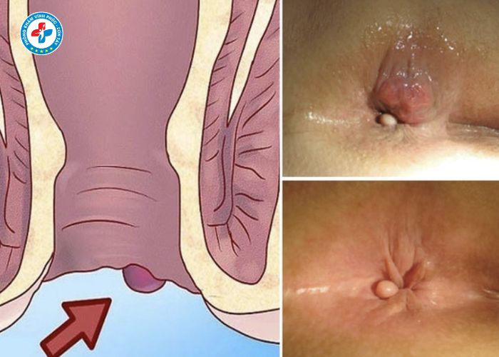 tiêm tiêu búi trĩ tại Vĩnh Phúc (3)