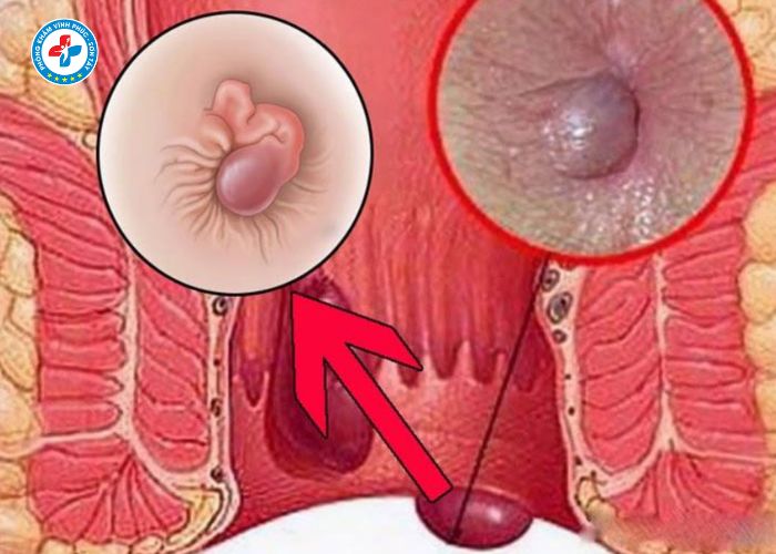 tiêm tiêu búi trĩ tại Vĩnh Phúc (4)