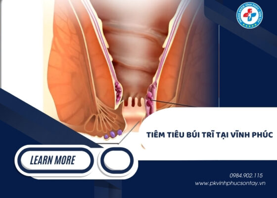 tiêm tiêu búi trĩ tại Vĩnh Phúc