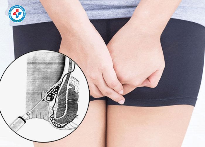 tiêm tiêu búi trĩ tại Vĩnh Phúc (6)