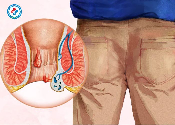 tiêm tiêu búi trĩ tại Vĩnh Phúc (7)