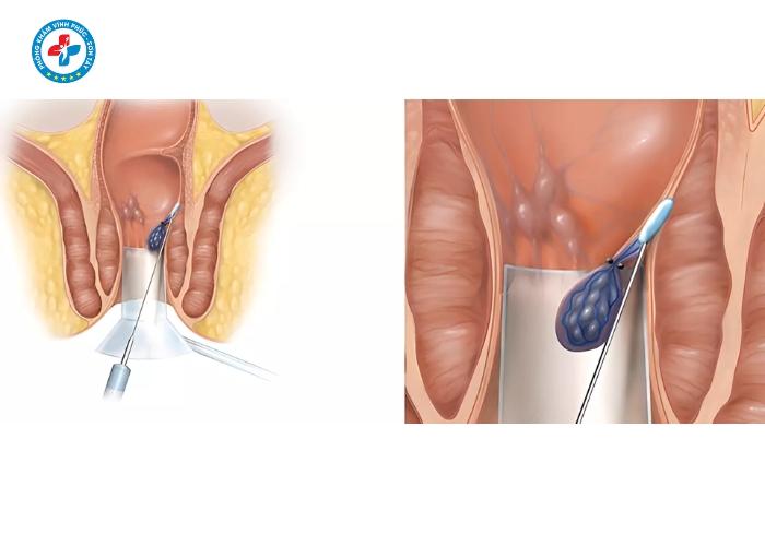 tiêm tiêu búi trĩ tại Vĩnh Tường (5)