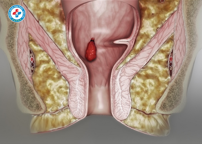 tiêm tiêu búi trĩ tại Vĩnh Tường (6)