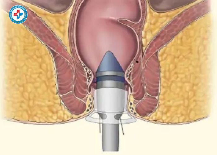 tiêm trĩ tại Sơn Tây (3)