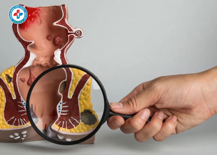 tiêm trĩ tại Sơn Tây (4)