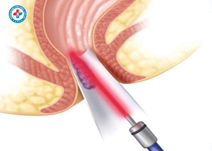 tiêm trĩ tại Sơn Tây (7)