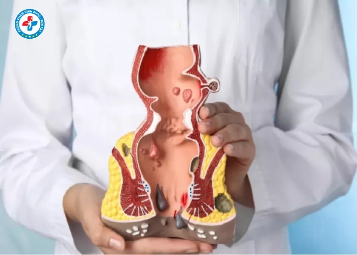 tiêm trĩ tại Vĩnh Tường (8)