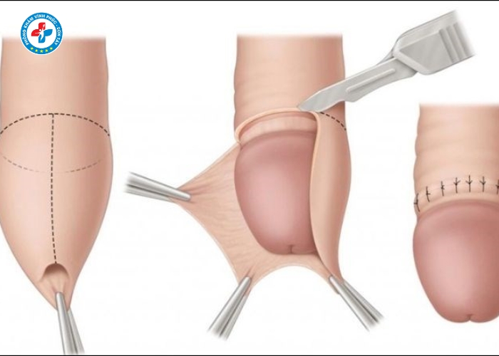 Dài bao quy đầu tại Sơn Tây (4)