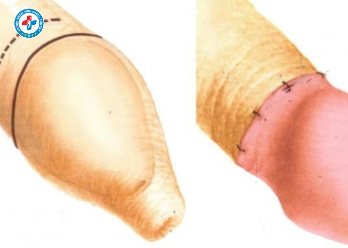 Dài bao quy đầu tại Sơn Tây (5)