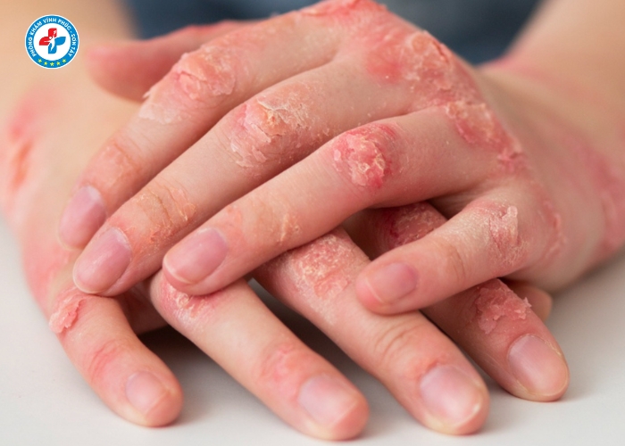 Điều Trị Giang Mai Nam Tại Sơn Tây (4) Điều Trị Giang Mai Nam Tại Sơn Tây (4)