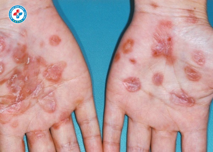 Điều Trị Lậu Nam Tại Sơn Tây (3)