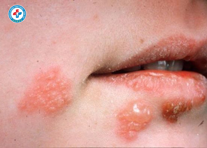 Điều Trị Lậu Nam Tại Sơn Tây (4)