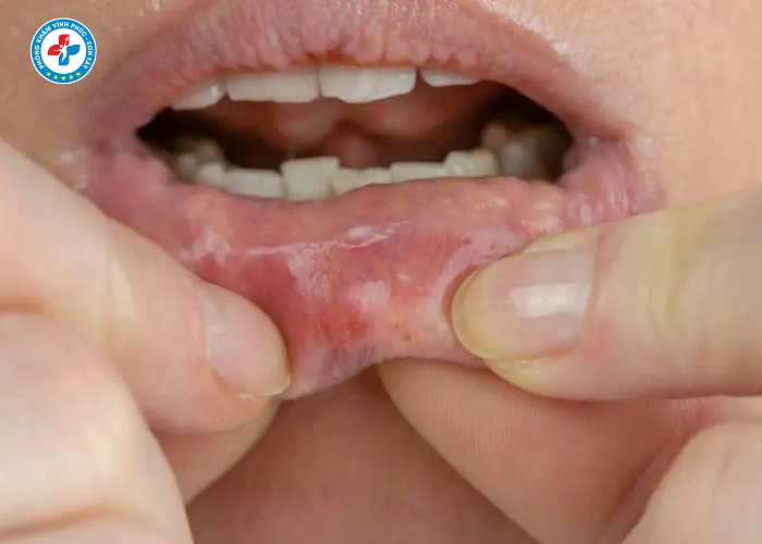 Điều Trị Lậu Nam Tại Sơn Tây (5)