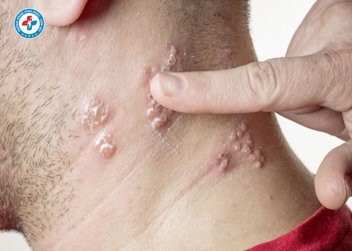 Điều Trị Lậu Nam Tại Sơn Tây (7)