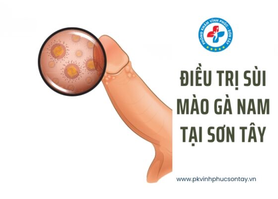 Điều Trị Sùi Mào Gà Nam Tại Sơn Tây (2)