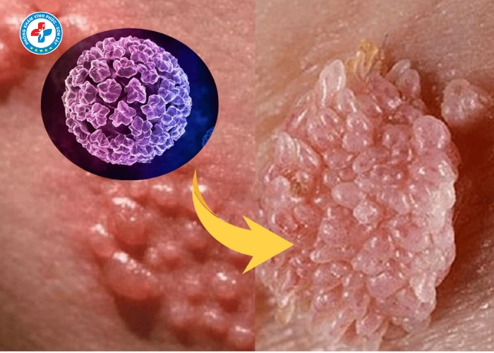 Điều Trị Sùi Mào Gà Nam Tại Sơn Tây (3)