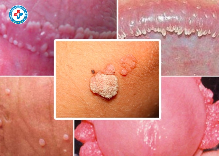 Điều Trị Sùi Mào Gà Nam Tại Sơn Tây (5)