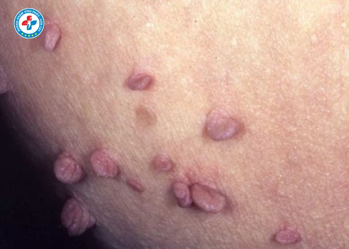 Điều Trị Sùi Mào Gà Nam Tại Sơn Tây (9)