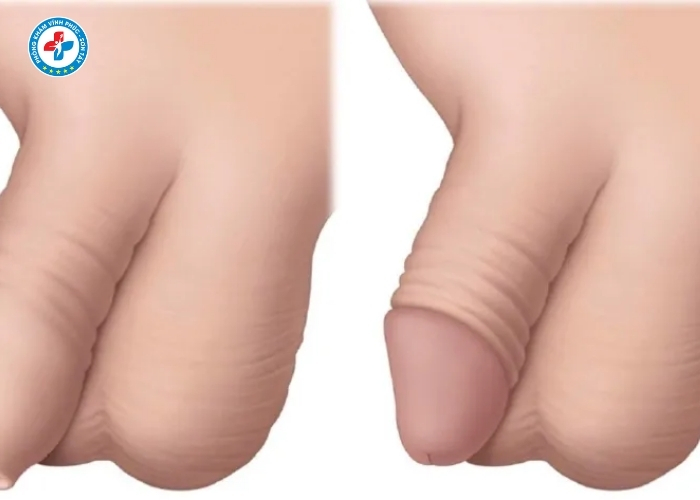 Hẹp bao quy đầu tại Sơn Tây (8)