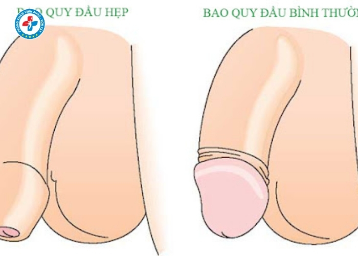 Hẹp bao quy đầu tại Sơn Tây (9)