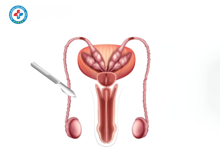 Phẩu thuật thắt ống dẫn tinh tại Sơn Tây (1)