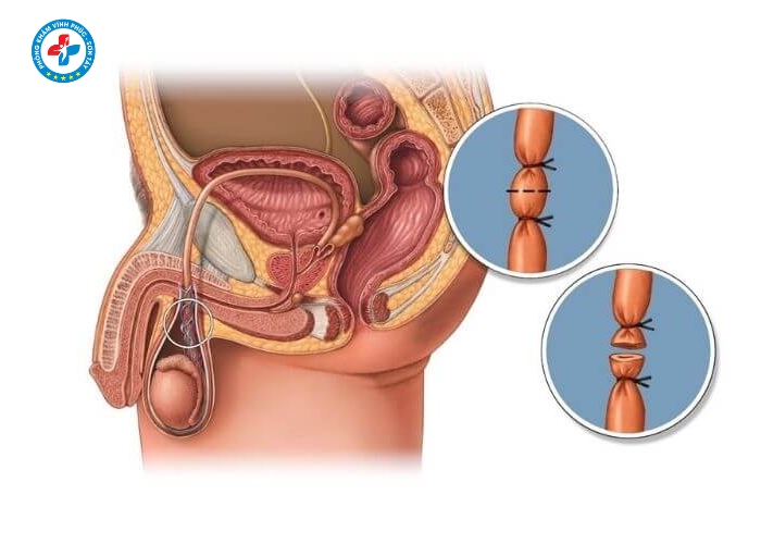 Phẩu thuật thắt ống dẫn tinh tại Sơn Tây (11)