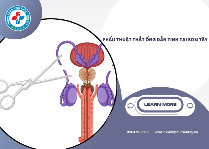 Phẩu thuật thắt ống dẫn tinh tại Sơn Tây (2)