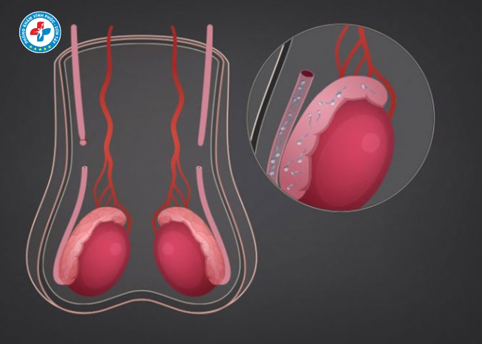 Phẩu thuật thắt ống dẫn tinh tại Sơn Tây (6)