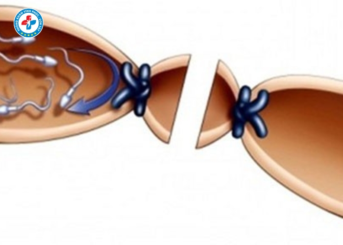 Thắt ống dẫn tinh tại Sơn Tây (1)