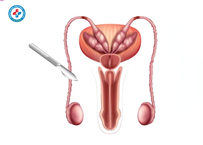 Thắt ống dẫn tinh tại Sơn Tây (3)