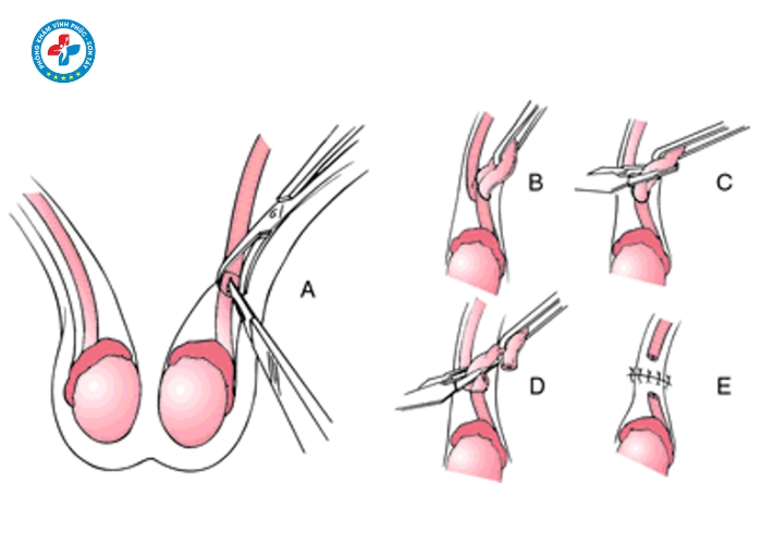 Thắt ống dẫn tinh tại Sơn Tây (5)