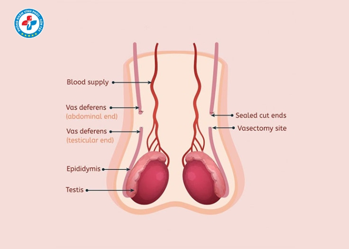 Thắt ống dẫn tinh tại Sơn Tây (6)