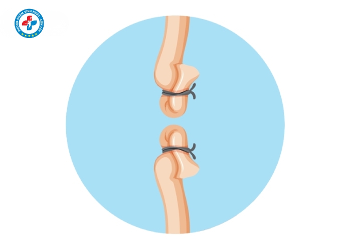 Thắt ống dẫn tinh tại Sơn Tây (7)