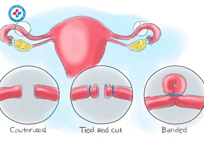 Thắt ống dẫn tinh tại Sơn Tây (9)
