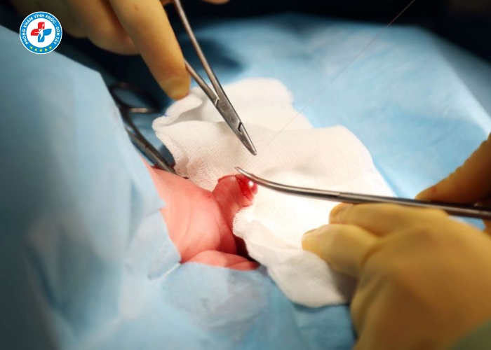 cắt bao quy đầu tại Sơn Tây (4) cắt bao quy đầu tại Sơn Tây (4)