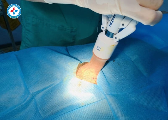 cắt bao quy đầu tại Sơn Tây (6) cắt bao quy đầu tại Sơn Tây (6)