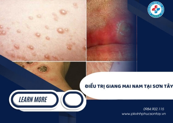 điều trị giang mai nam tại Sơn Tây