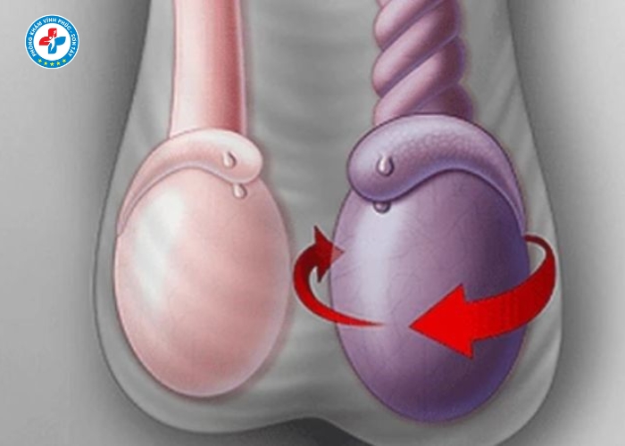 điều trị viêm mào tinh tại Sơn Tây (3)