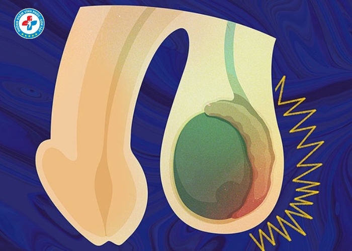 điều trị viêm mào tinh tại Sơn Tây (5)