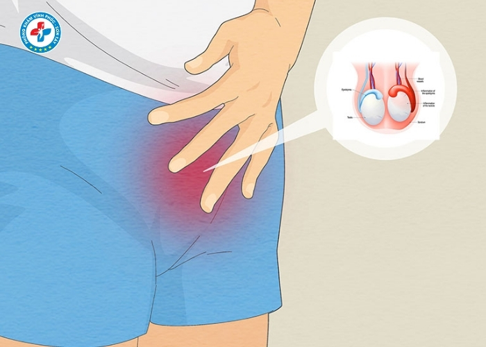 điều trị viêm tinh hoàn tại Sơn Tây (7)
