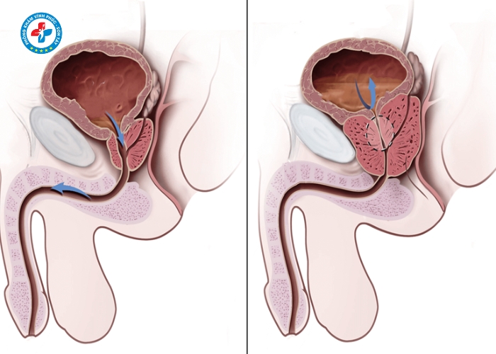 điều trị viêm tuyến tiền liệt tại Sơn Tây (5)