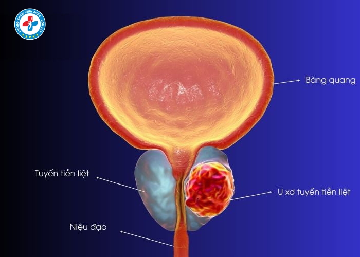 điều trị viêm tuyến tiền liệt tại Sơn Tây (8)