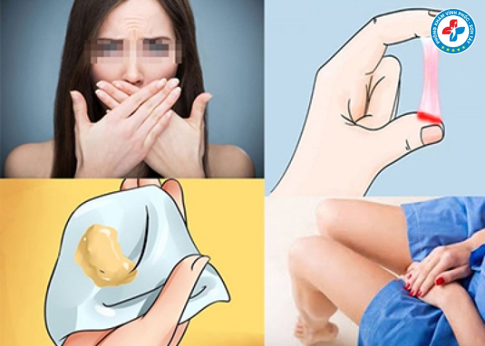 Dấu hiệu bị viêm nhiễm phụ khoa nặng (2) Dấu hiệu bị viêm nhiễm phụ khoa nặng (2)