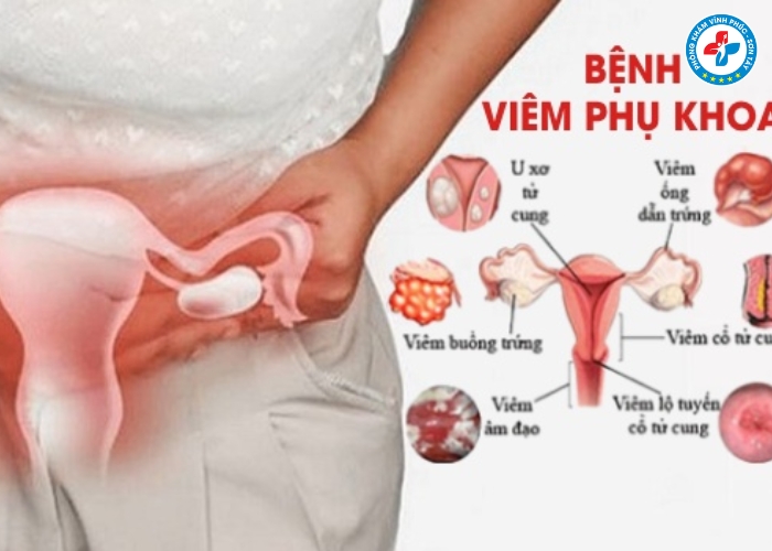 Dấu hiệu bị viêm nhiễm phụ khoa nặng (4) Dấu hiệu bị viêm nhiễm phụ khoa nặng (4)