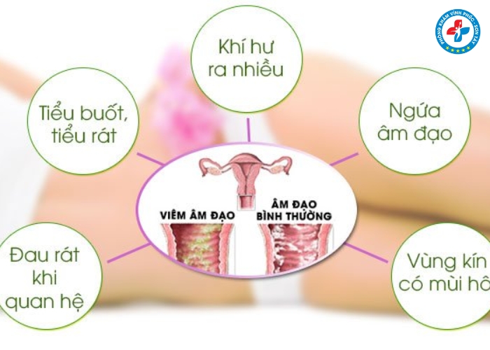Dấu hiệu bị viêm nhiễm phụ khoa nặng Dấu hiệu bị viêm nhiễm phụ khoa nặng