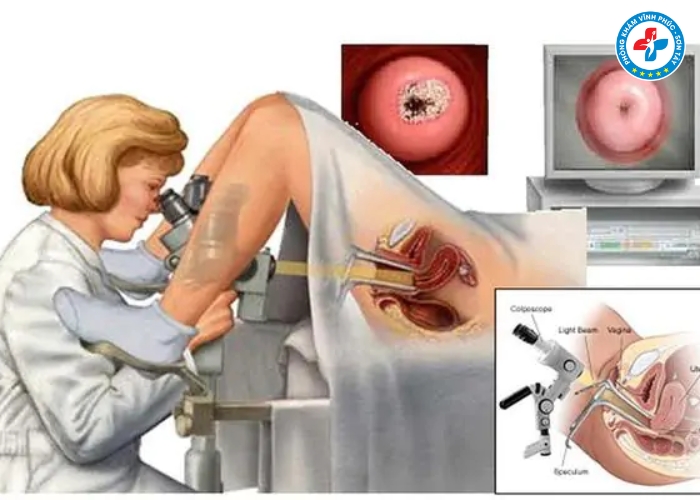 Cách nhận biết viêm lộ tuyến cổ tử cung (2)