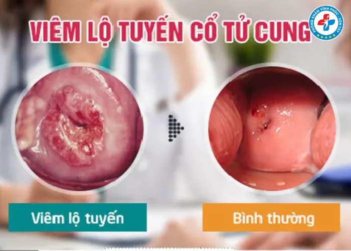 Cách nhận biết viêm lộ tuyến cổ tử cung (3)