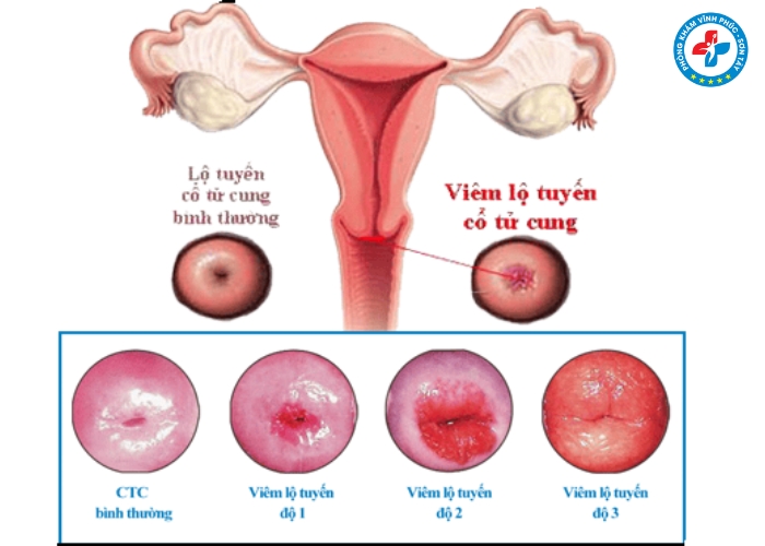 Cách nhận biết viêm lộ tuyến cổ tử cung (4)