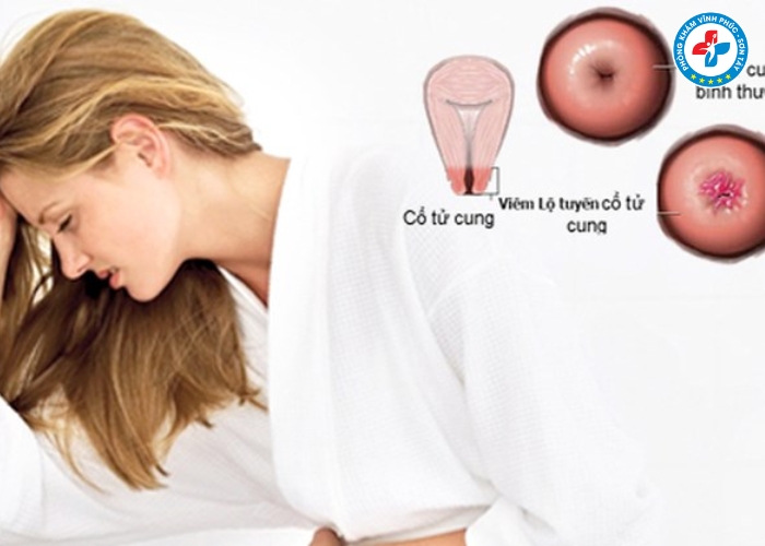 Cách nhận biết viêm lộ tuyến cổ tử cung (5)