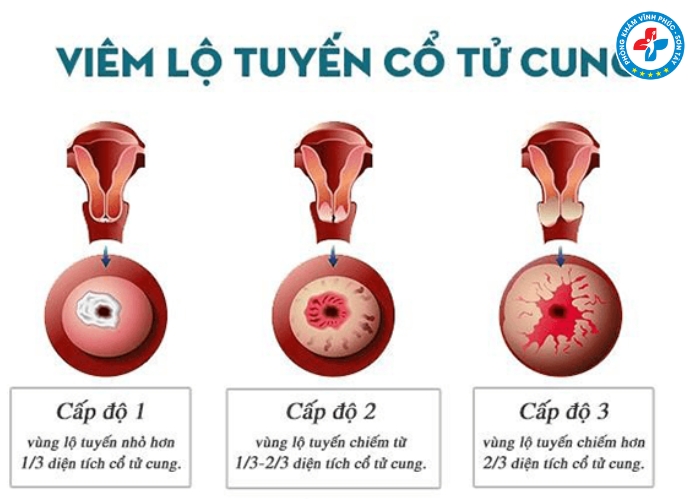 Cách nhận biết viêm lộ tuyến cổ tử cung